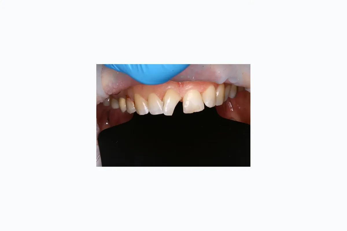 До лікування - Реставрація переднього різця
